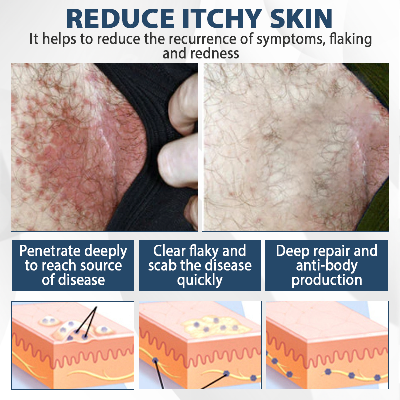 ATTDX® ManGuard HPV Wart Healing Cream